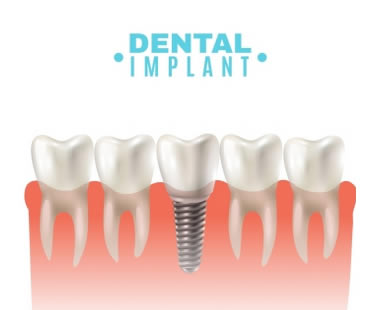 How Dental Implants Can Preserve Bone