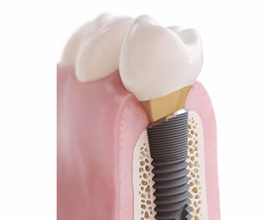 Choosing a Professional for Your Dental Implants in Toronto