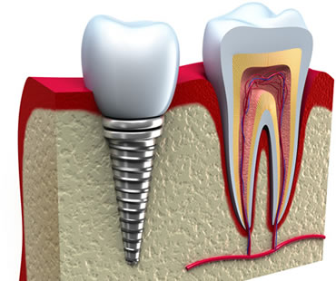 dental implants dentist in Toronto