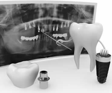 Recommended Diet Following Dental Implant Surgery