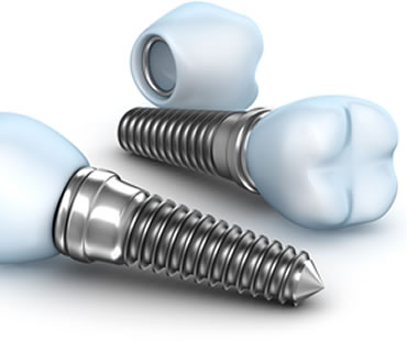 Implant dentist in Toronto