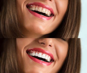 Make Your Big Day Special With Teeth Whitening